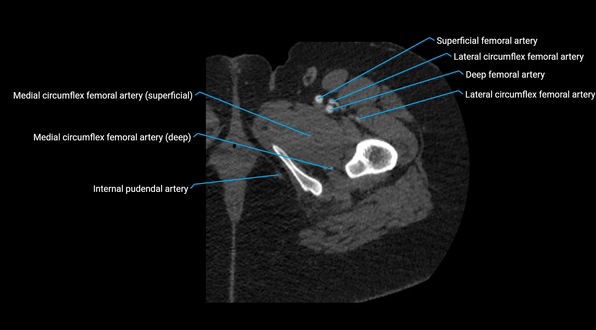 CTA lower limb cross sectional anatomy labelled image _75.webp